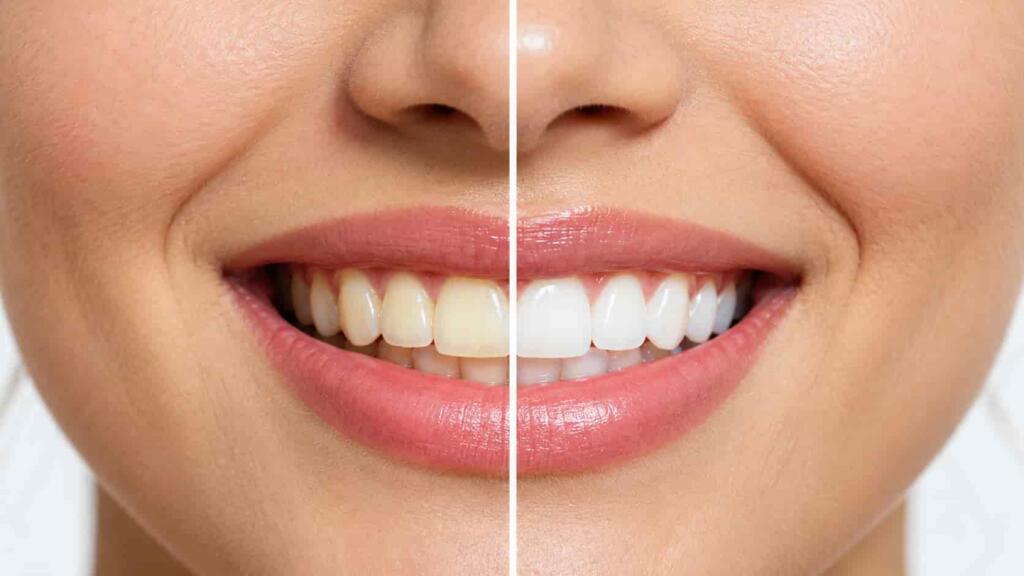 Clareamento dental: como funciona e quando aparecem os resultados