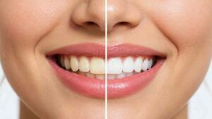 Clareamento dental: como funciona e quando aparecem os resultados