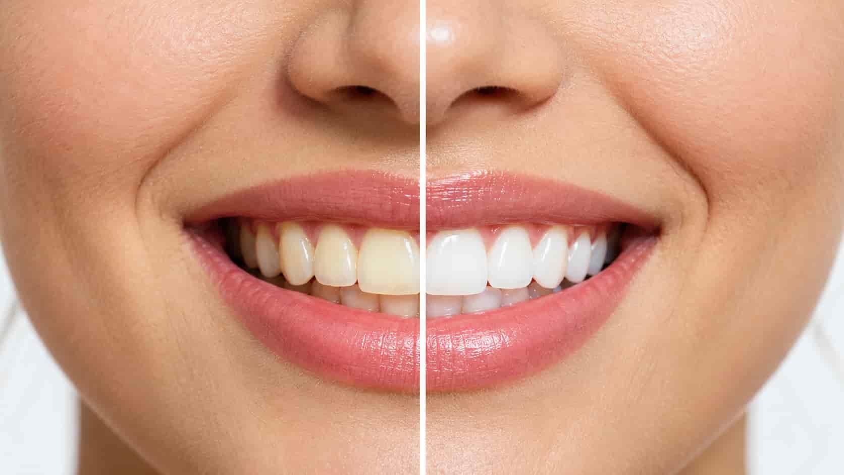 Clareamento dental: como funciona e quando aparecem os resultados